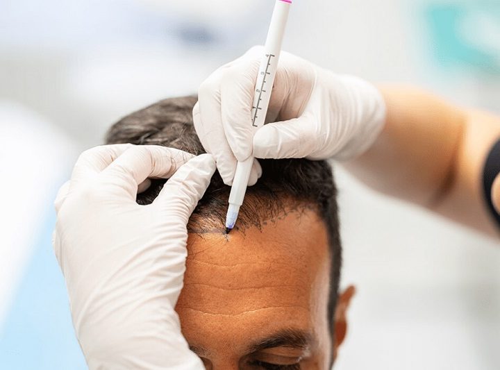 Why are there different costs for hair transplantation between the UK and Turkey?