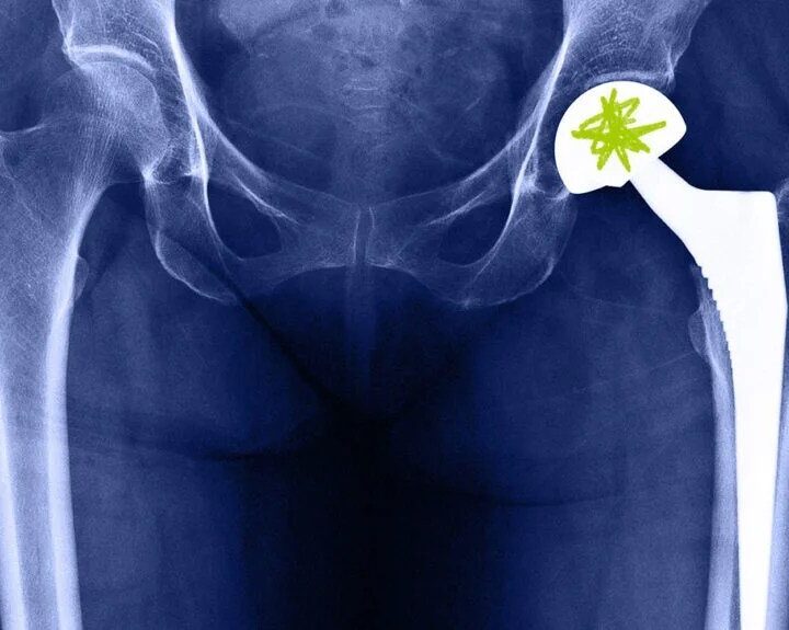 How Long Will I Be On Pain Medication After Hip Replacement Surgery: Insights & Timeline