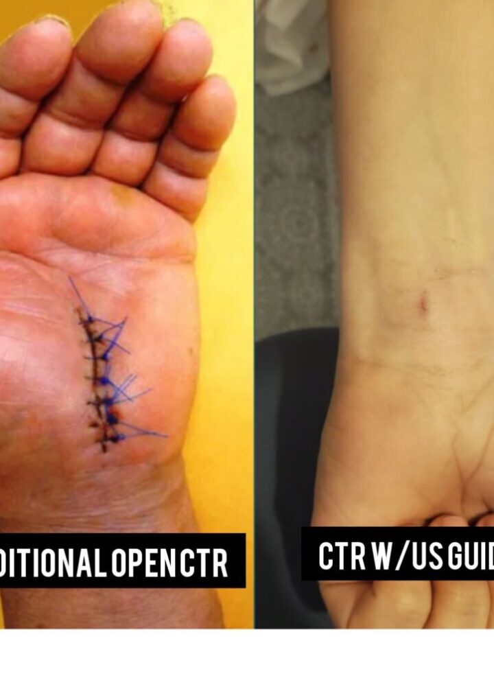 Cost Of Carpal Tunnel Surgery Without Insurance: What To Expect