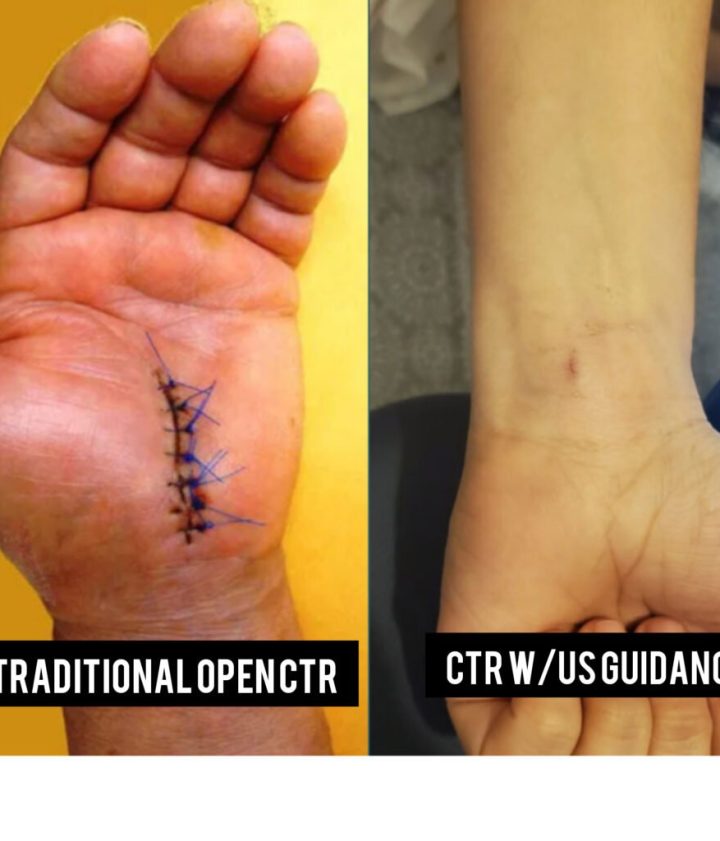 Cost Of Carpal Tunnel Surgery Without Insurance: What To Expect